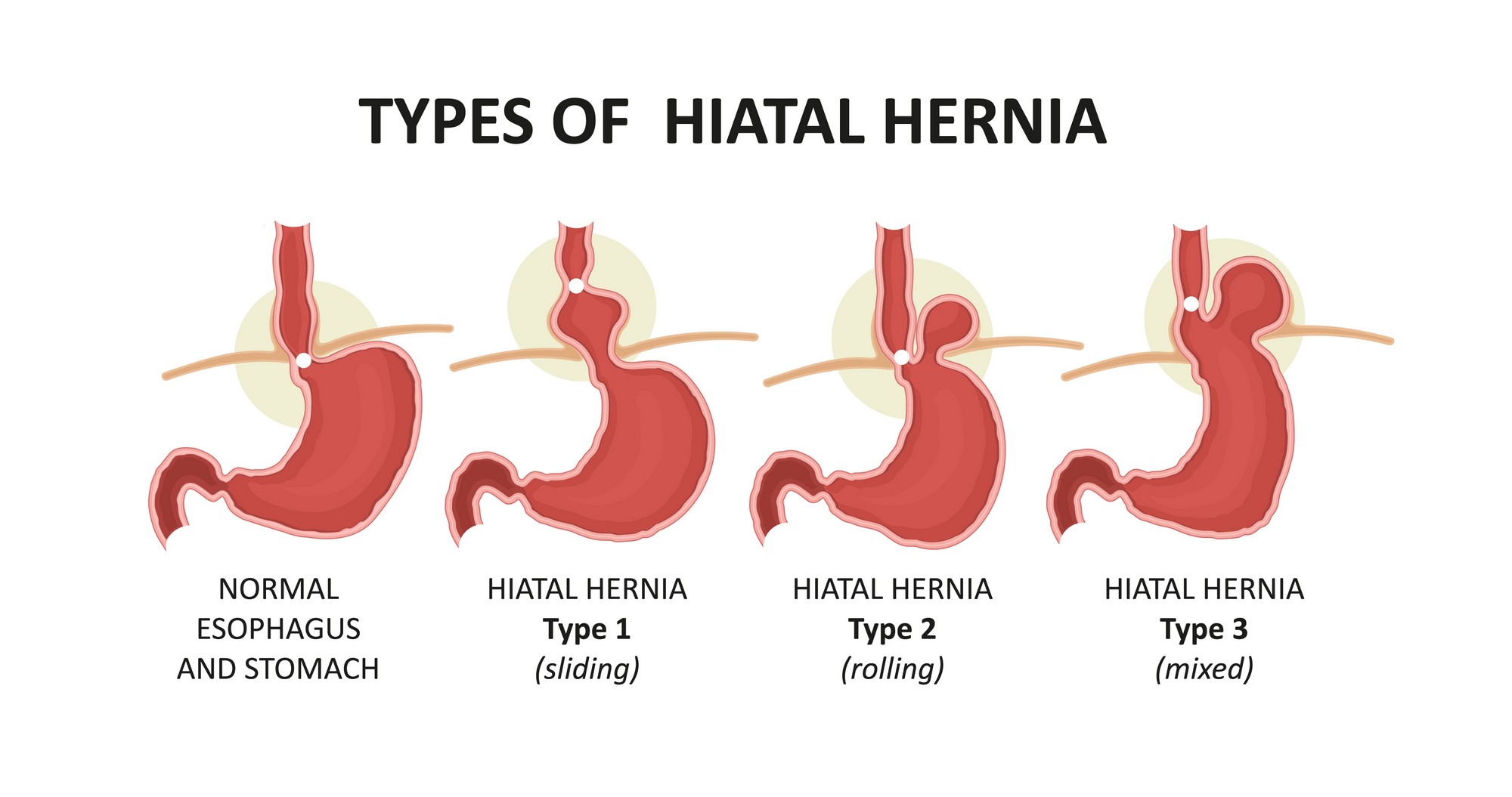 Hiatus Hernia Hiatal Hernia Hiatus Hernia Hiatal Hernia