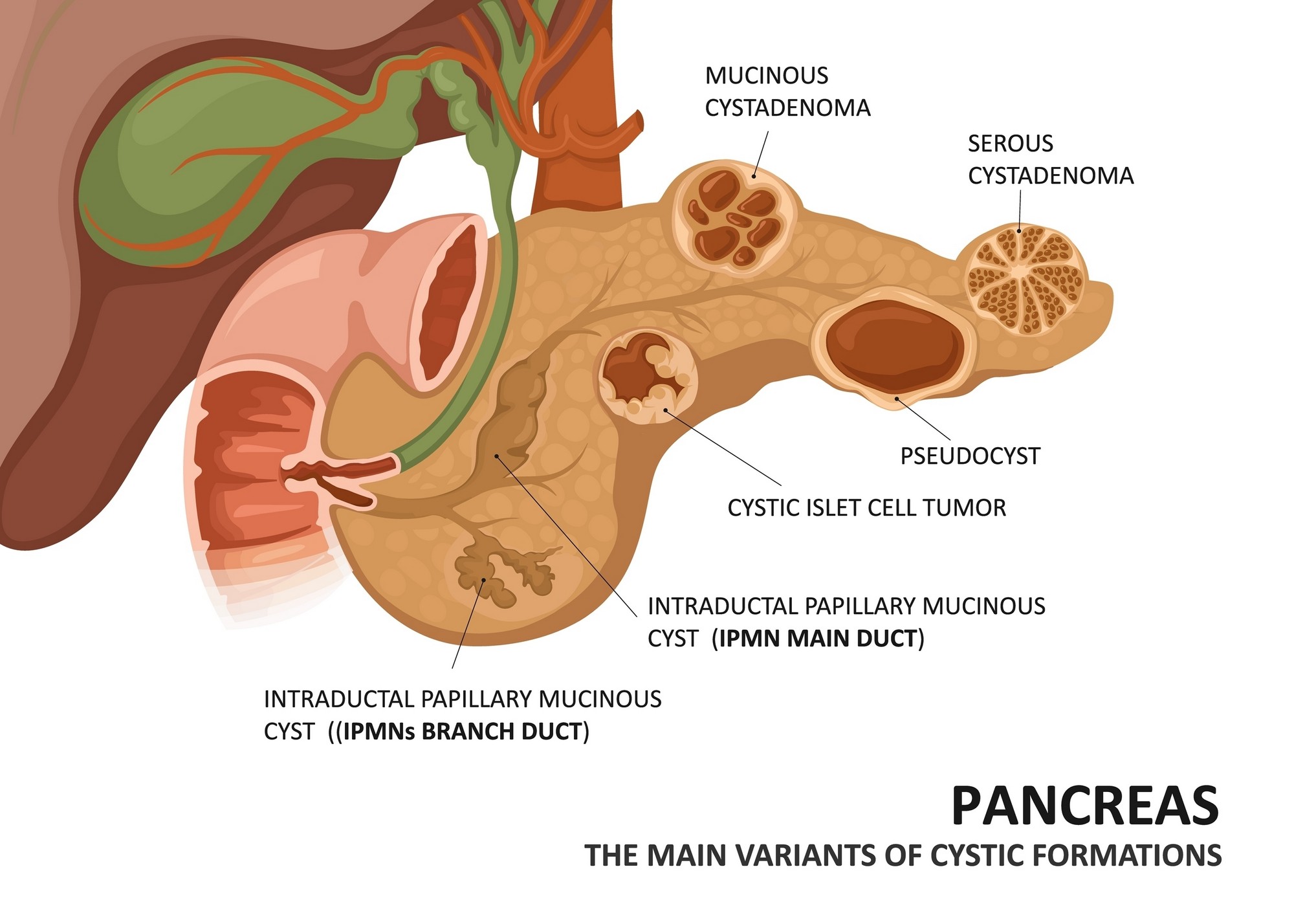 pancreatic-cysts