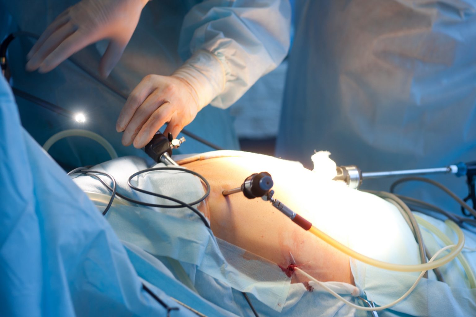 Gallbladder Surgery - Cholecystectomy – Gallbladder removal ...